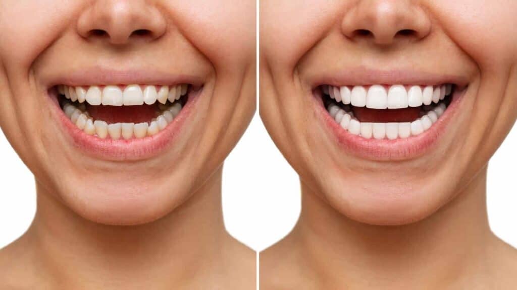 Contact Aspire White for teeth whitening services – Get in touch with Cheltenham today
