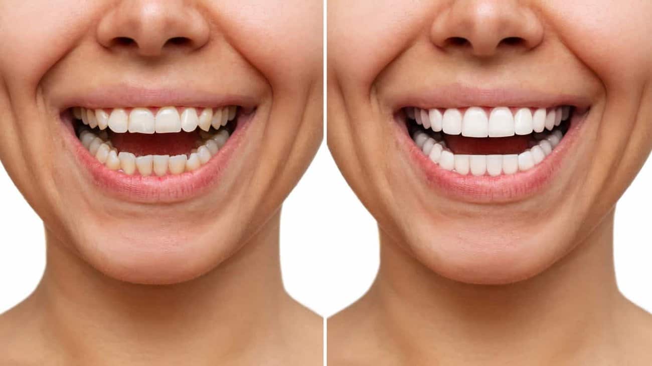 Contact Aspire White for teeth whitening services – Get in touch with Cheltenham today
