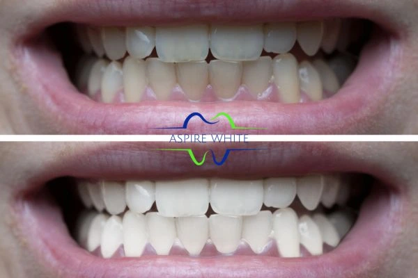 1 hour laser teeth whitening before and after results Cheltenham