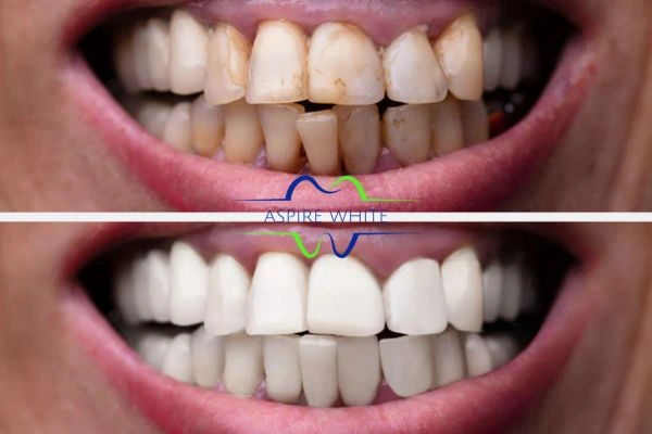 Before and after results of laser teeth whitening Cheltenham Book in online today!