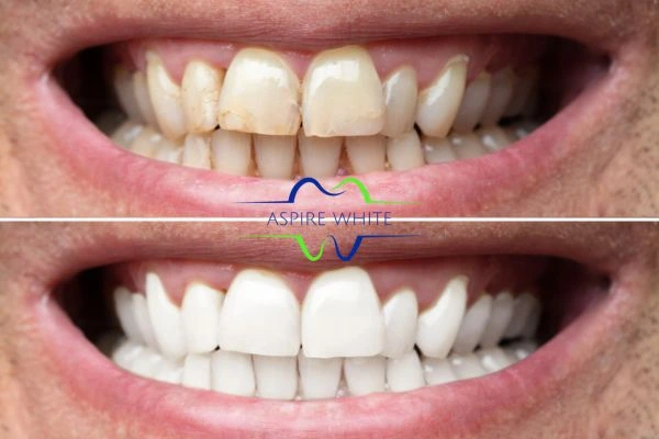 Achieve a radiant smile with professional laser teeth whitening Cheltenham